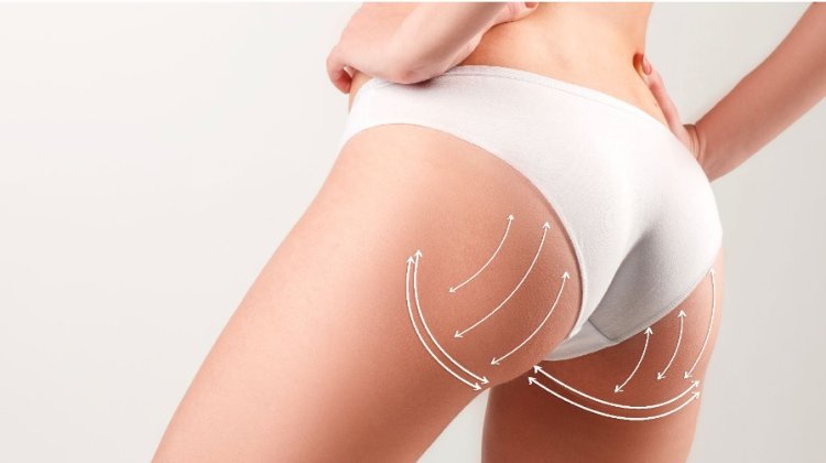 Differences Between Butt Augmentation and Brazilian Butt Lift