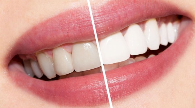 Evde Çok Kolay Bir Şekilde Uygulayabileceği 13 Diş Beyazlatma Yöntemi